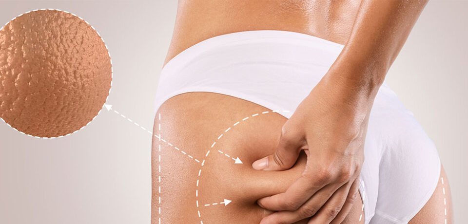 cellulite