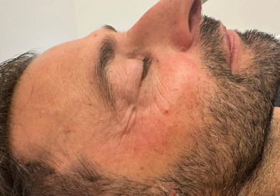 Trattamento dermorigenerante avanzato efetto