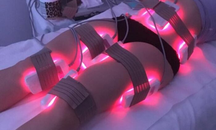 lipolaser