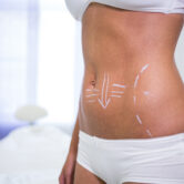 lipolaser-chic_estetica lipolaser chic estetica Castellammare del Golfo