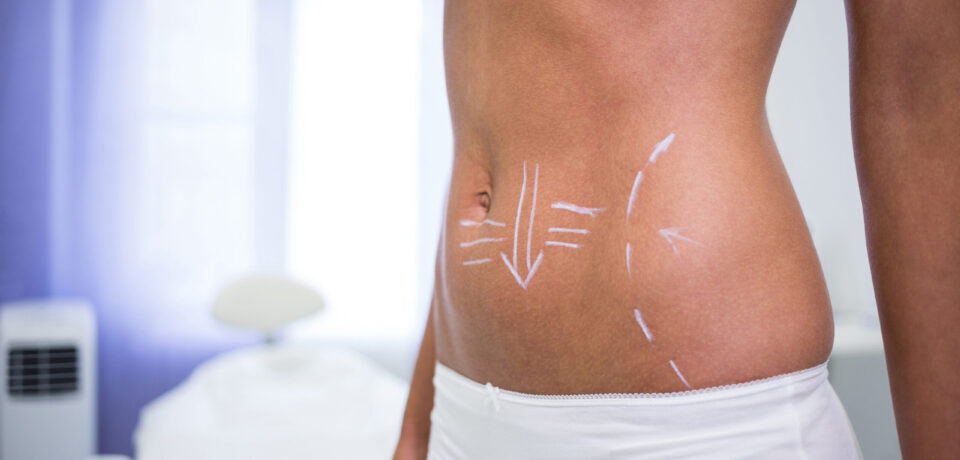 lipolaser chic estetica Castellammare del Golfo