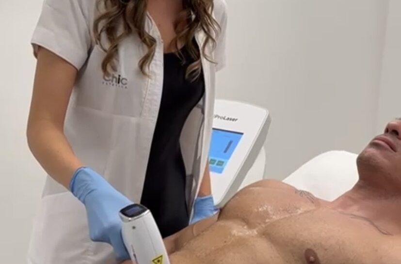 epilazione laser chic estetica